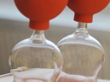 cupping therapy